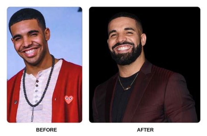 Drake | Surgery Rumors 2024